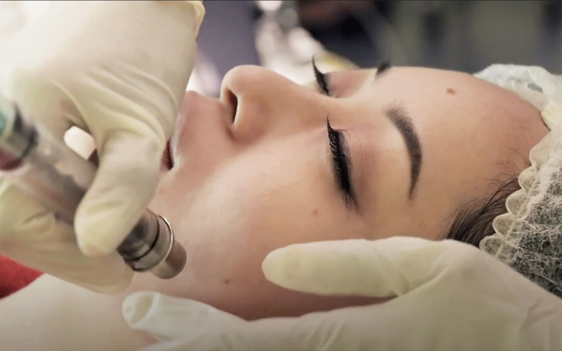 The microdermabrasion procedure helps removing dead skin cells