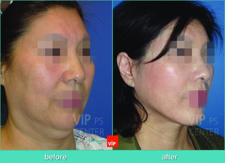 VIP International Plastic Surgery Center In Seoul Helps You Reverse The