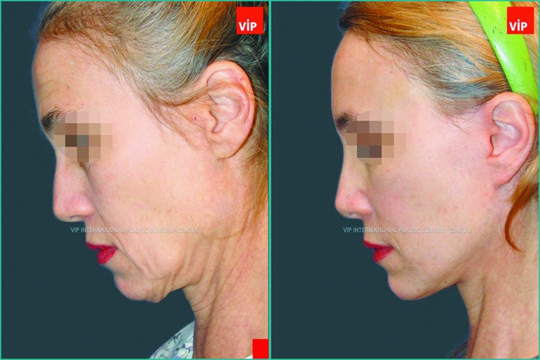 VIP International Plastic Surgery Center In Seoul Helps You Reverse The