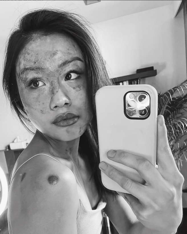 Burns Survivor Charlene Chew on Her Journey to Healing and Her Best
