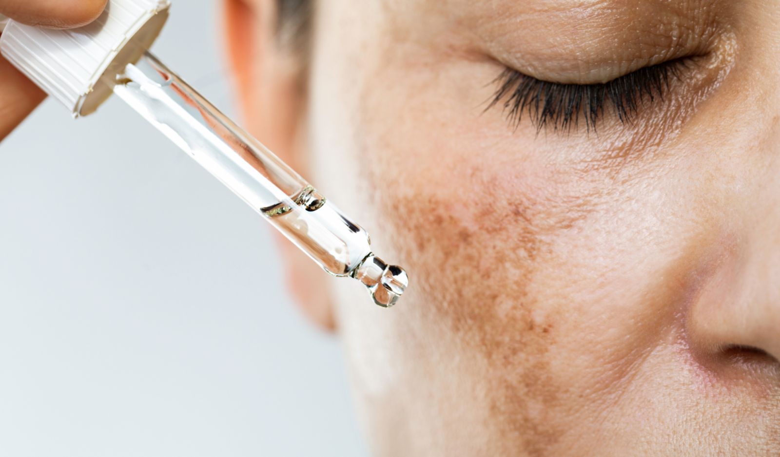 While dark spots and scarring are natural occurrences, healing your skin inside out helps with reducing the stress over inflamed skin. (Image: iStock)