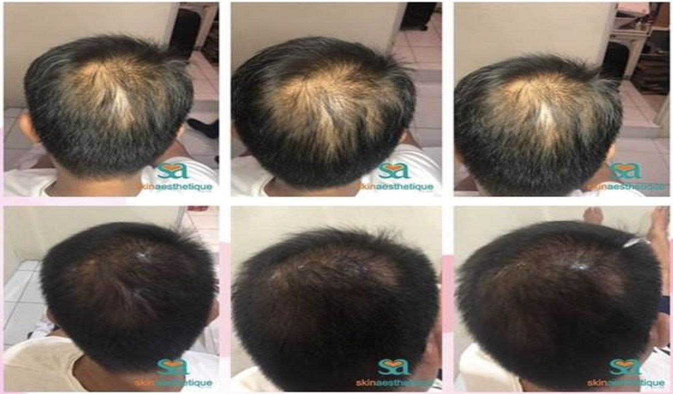 There are many reasons why your hair is falling out. In this article, hair regeneration expert Dr Halah Taha tells us what causes it and why Regenera Activa is the antidote (Photo: Pexels)