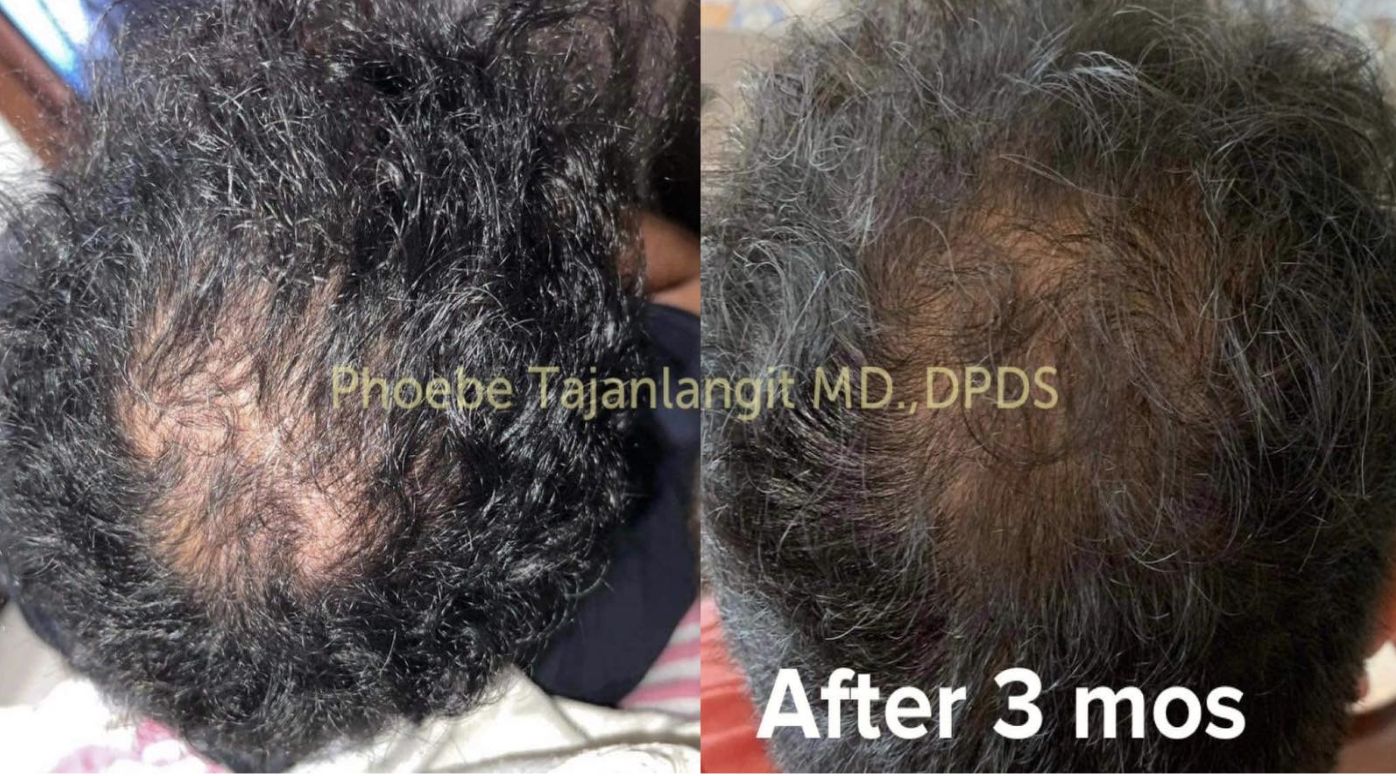 There are many reasons why your hair is falling out. In this article, hair regeneration expert Dr Halah Taha tells us what causes it and why Regenera Activa is the antidote (Photo: Pexels)