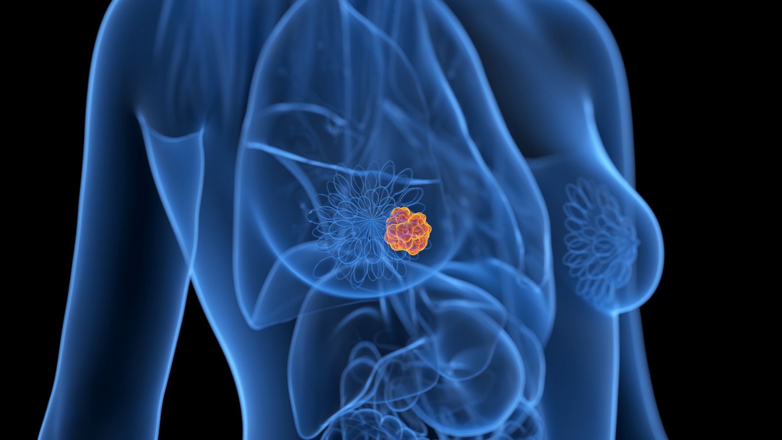 Breast cancer, illustration