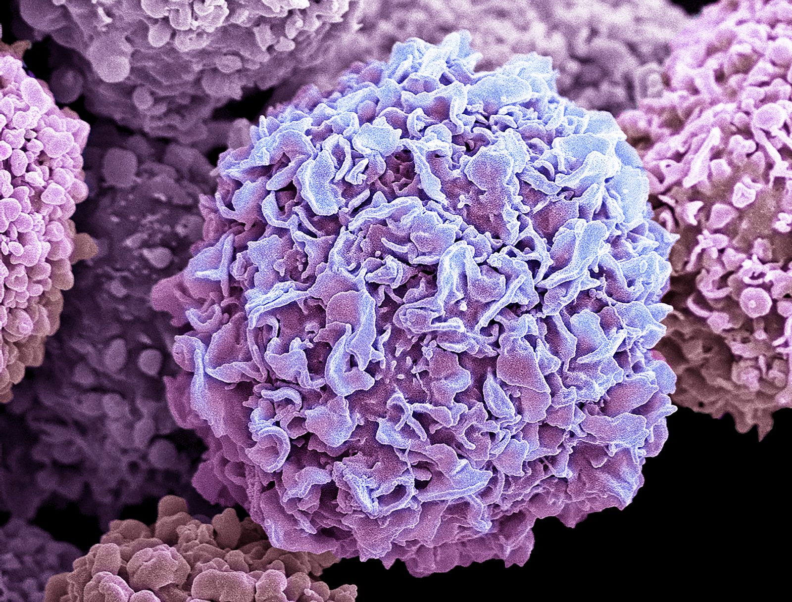 Breast cancer cells. Coloured scanning electron micrograph (SEM) of breast cancer cells. The cells shows numerous processes and microplicae (fine surface folds). These features are characteristic of highly mobile cells, and enable cancerous cells to spread (metastasis) rapidly round the body, and invade other organs and tissues. Cancer cells divide rapidly and chaotically, and may clump to form malignant tumours. The tumours often invade and destroy surrounding tissues. Breast cancer is the most common form