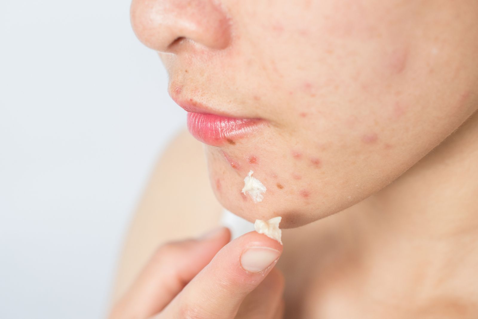 In this article, Tatler asks how Dr Vicki Belo treats acne (Photo: Getty Images)