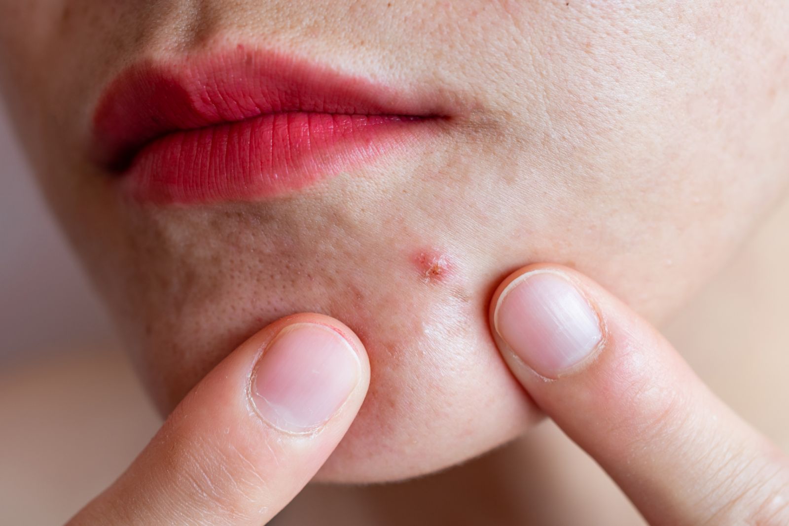 Dr Vicki Belo recommends microcoring for acne scars (Photo: Getty Images)