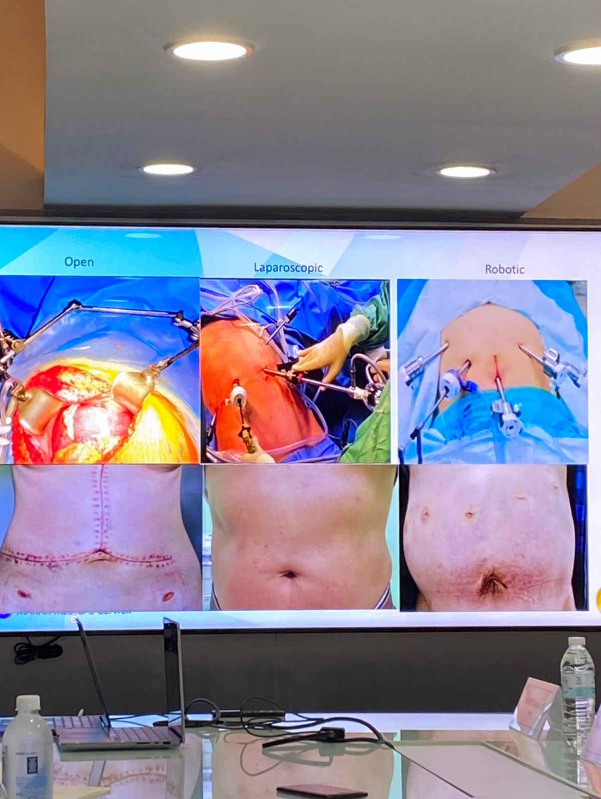 The Da Vinci XI robotic surgery is less invasive (Photo: Jove Moya)
