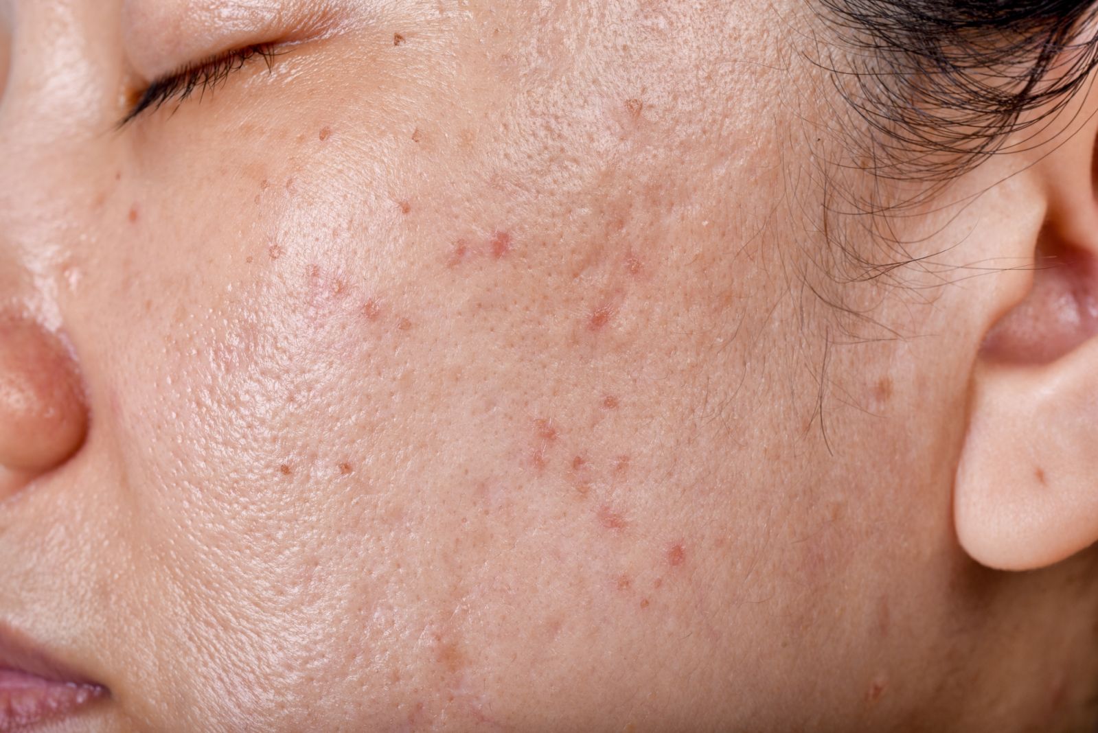 Suffering from an acne breakout? Your skin needs a sunscreen product that won’t exacerbate congestion or inflammation (Photo: Getty Images)