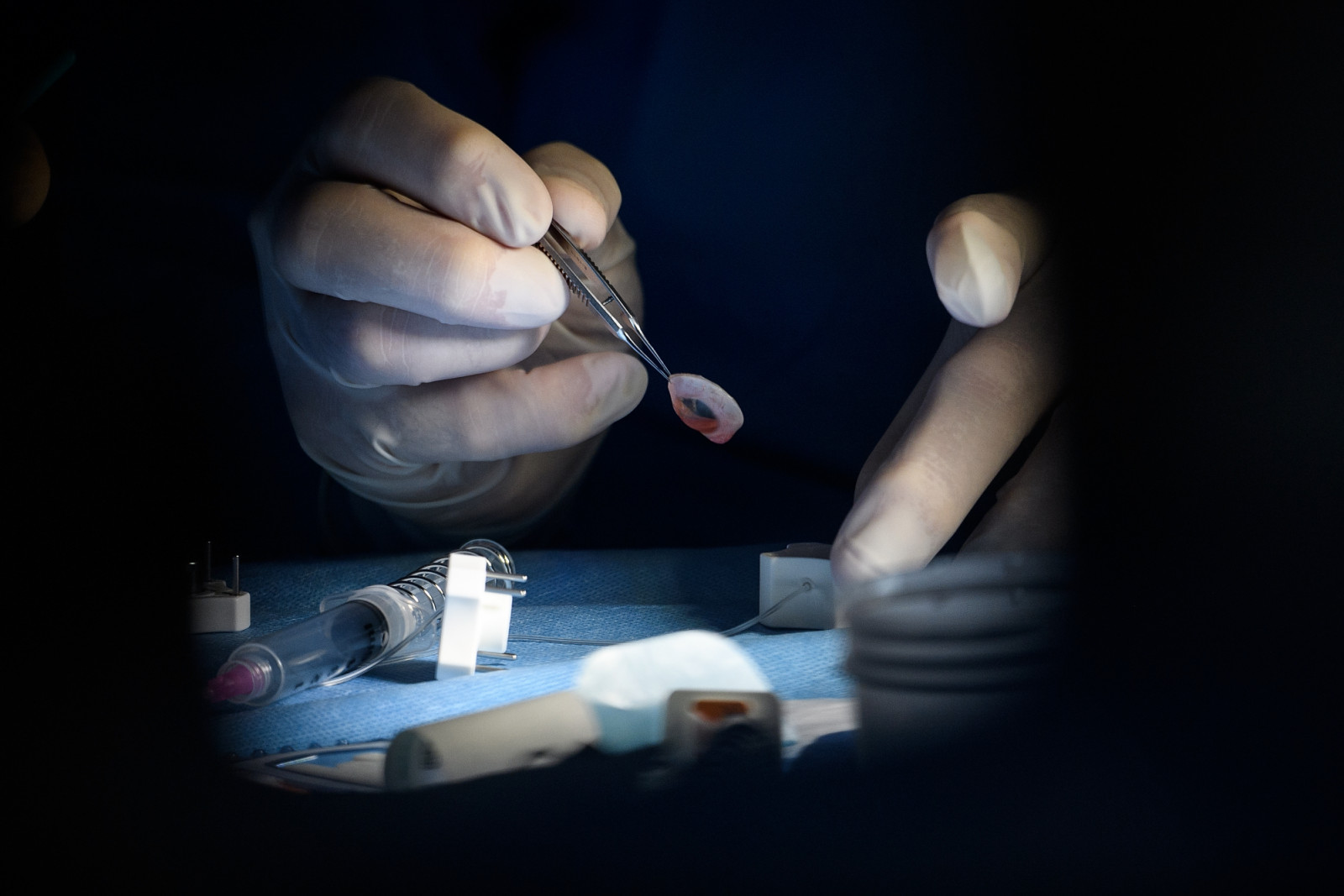 A doctor performing a cornea transplant on a patient with Reis-Buckler syndrome, a rare genetic condition that causes disintegration of the Bowman’s layer of the cornea (Photo: Getty Images)