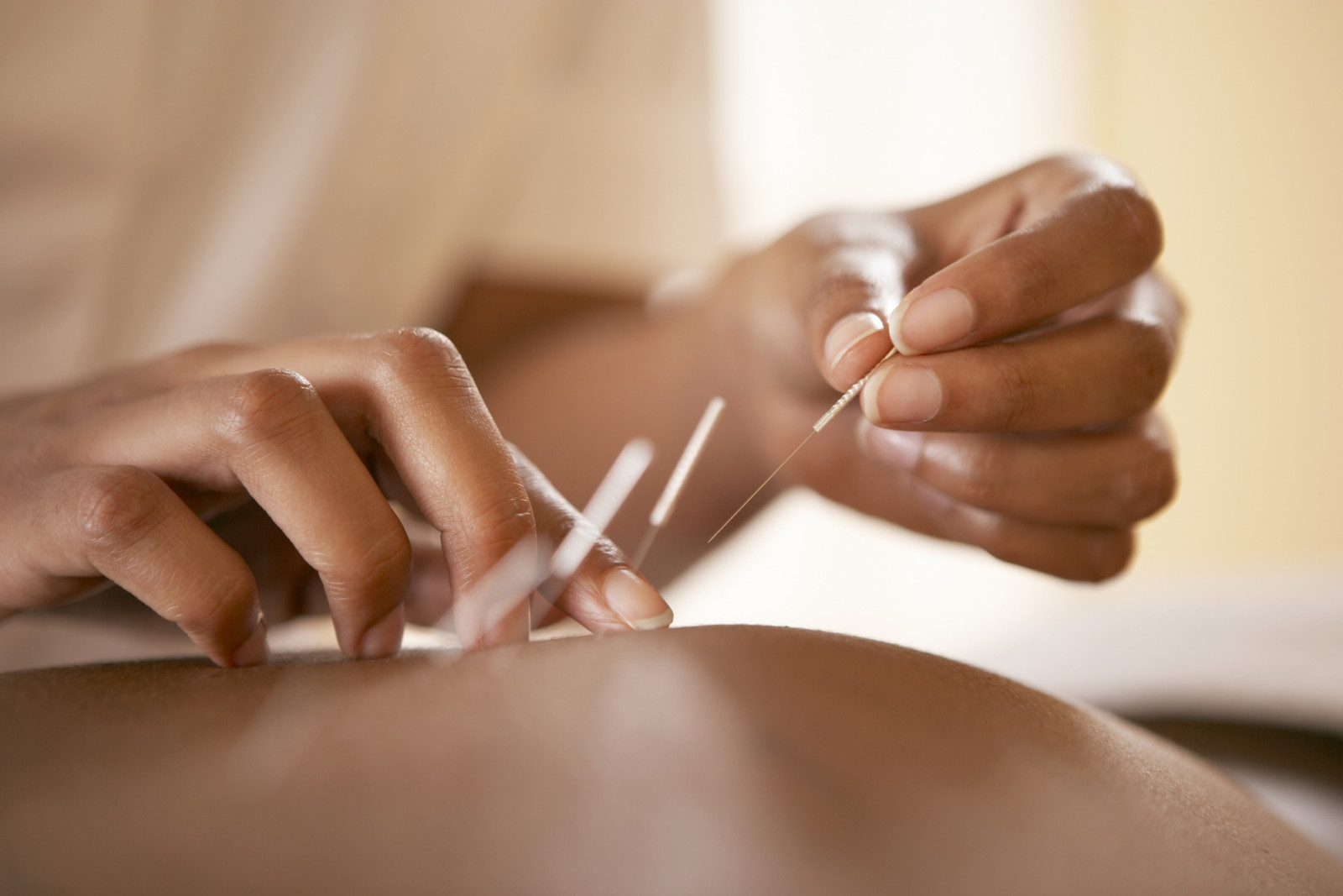 Acupuncture. Acupuncturist inserting a needle into a client's back. This traditional Chinese practice uses needles to restore an energy flow through specific points on the skin. It is used to relieve pain and to treat a wide range of disorders. Modern Western medicine explains the pain-relieving effects by suggesting that the needles stimulate the release of endorphins, the body's natural painkillers.