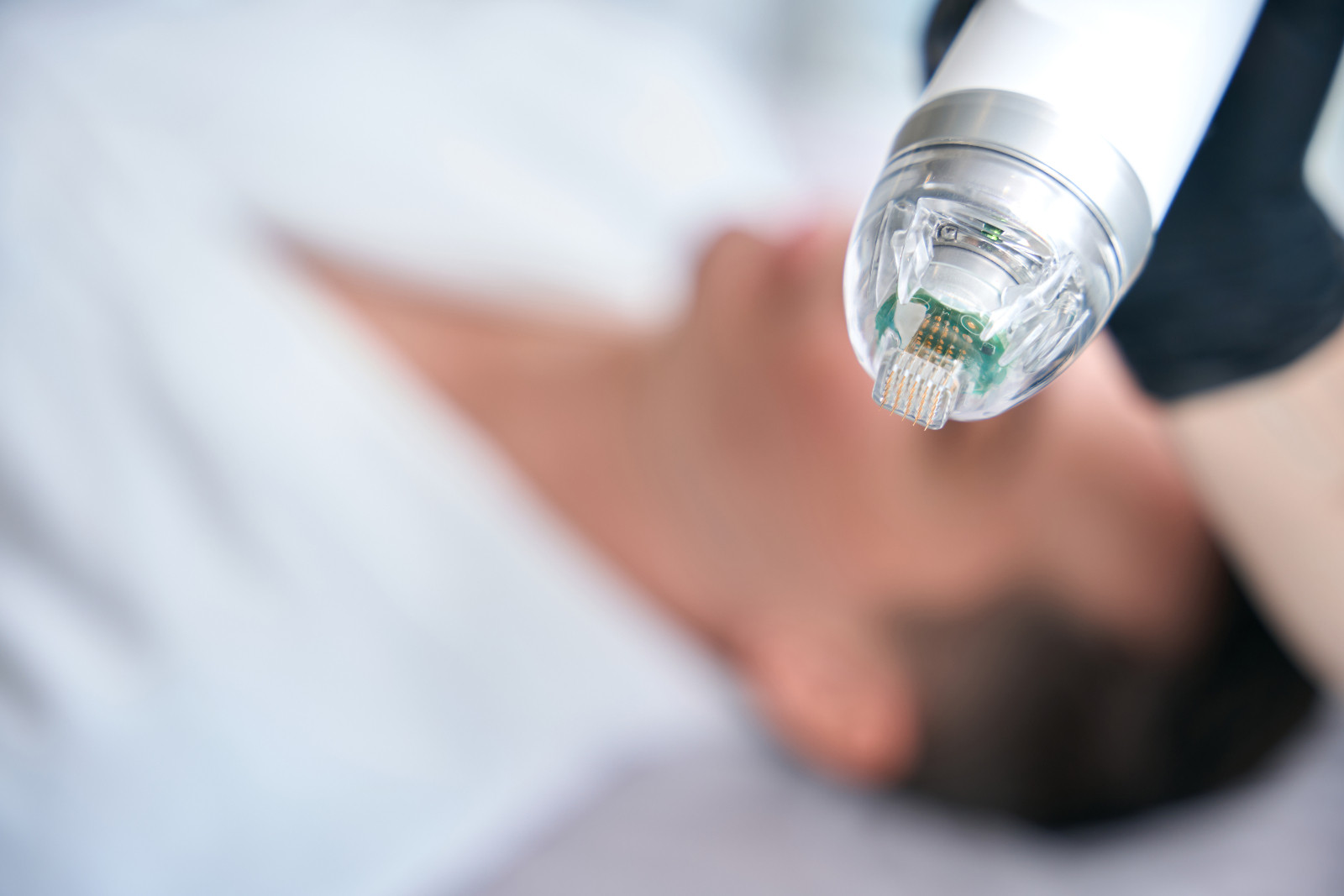In microneedling, tiny, fine needles are used on the skin’s surface to create micro-injuries (Photo: Getty Images)