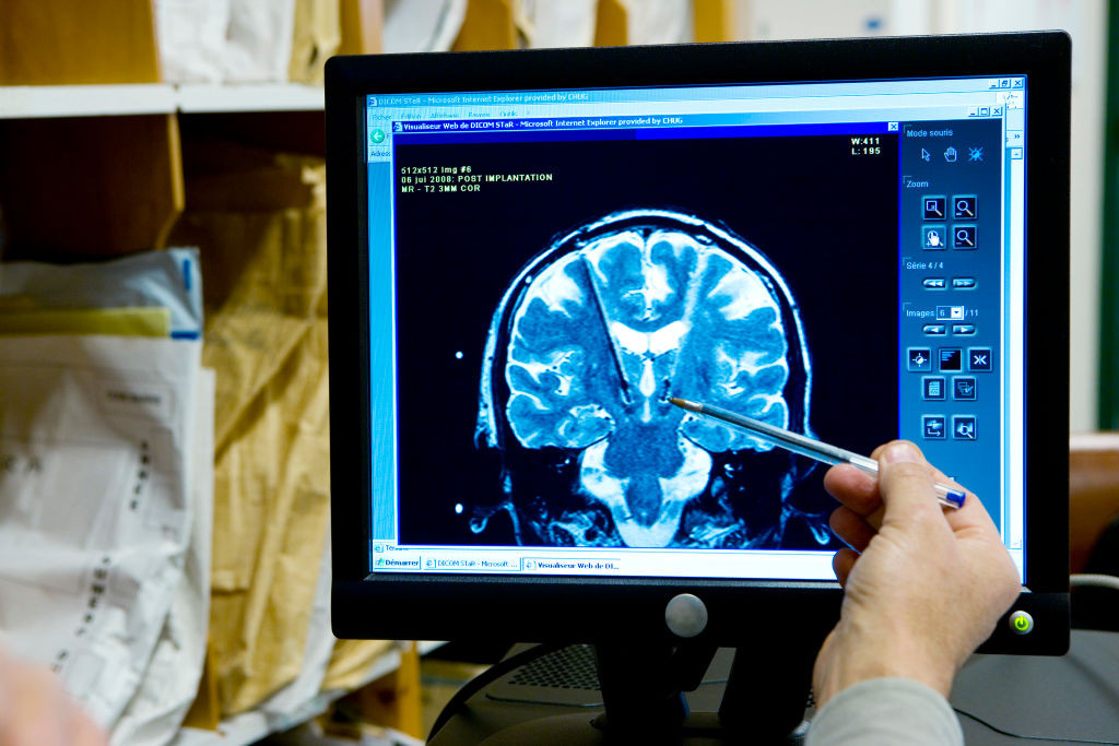 Photo Essay From Hospital. Grenoble University Hospital Michallon Hospital Department Of Neurology Unit 'Movement Disorder'. Mri Of A 30 Year Old Patient Suffering From Dystonia, Treated By A High Frequency Deep Brain Stimulation By Implantation Of Electrodes At The Level Of The Internal Paladium. These Electrodes Are Linked To A Neurostimulator, Box Implanted Under The Clavicle. (Photo By BSIP/UIG Via Getty Images)