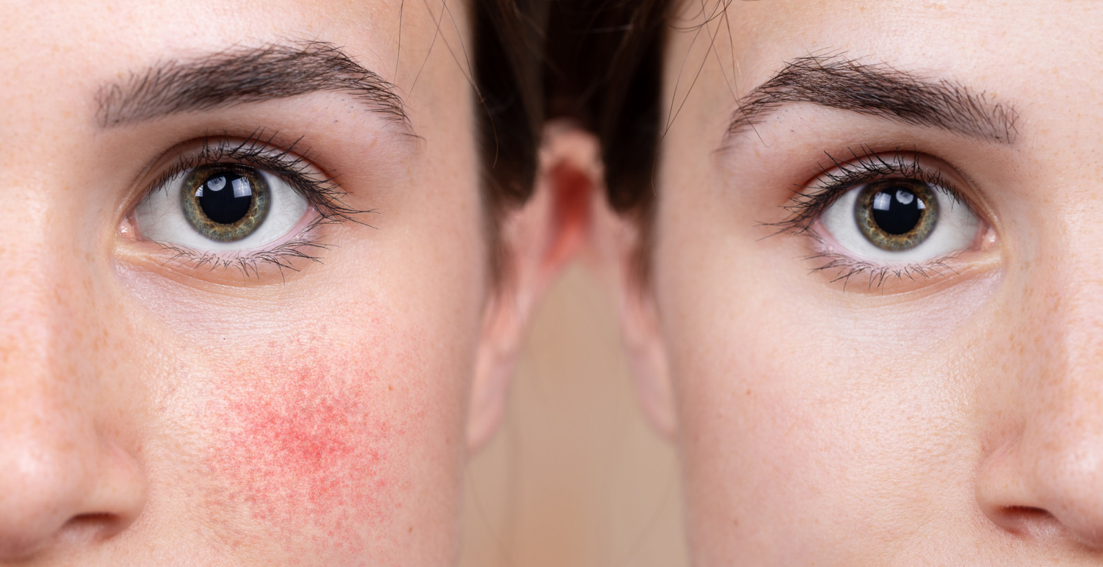 A young Caucasian girl shows the before and after results of intensive light surgery to remove the symptoms of rosacea. Noticeable reduction in cheens